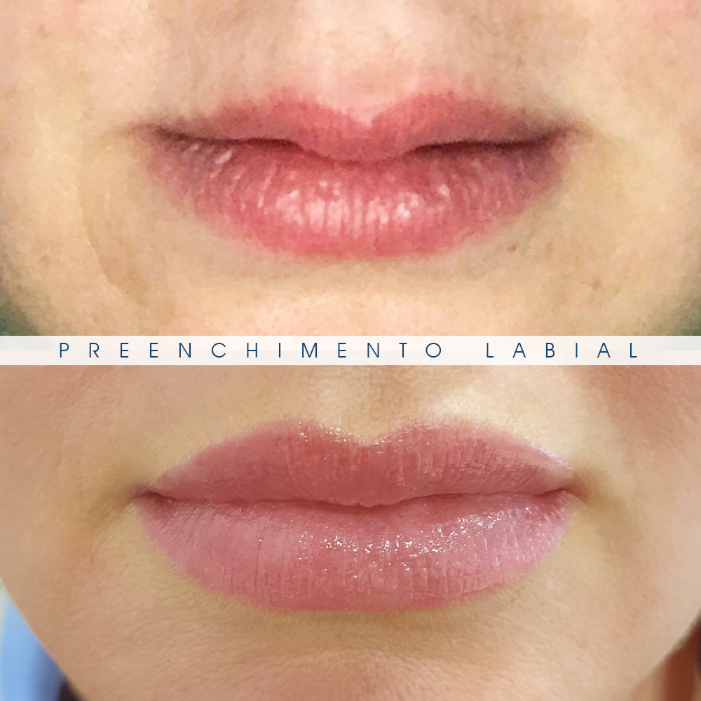 Preenchimento_Labial_Clitrofa