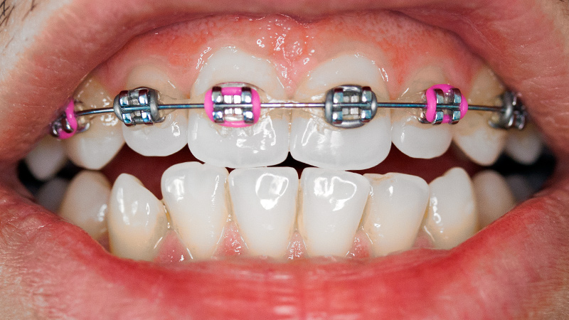 Ortodontia Fixa e Removível